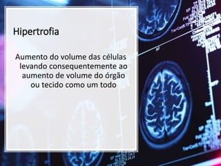 Hipertrofia
Aumento do volume das células
levando consequentemente ao
aumento de volume do órgão
ou tecido como um todo
 