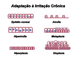 Epitélio normal
Hipertrofia
Hiperplasia
Atrofia
Metaplasia
Displasia
Adaptação à Irritação Crônica
 