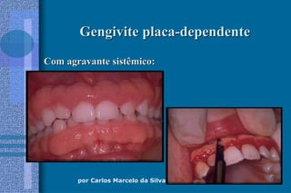 por Carlos Marcelo da Silva Figueredo, DDS, MDSc, PhD
Gengivite placaGengivite placa--dependentedependente
Com agravante sistêmico:Com agravante sistêmico:
 