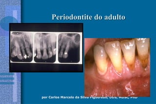 por Carlos Marcelo da Silva Figueredo, DDS, MDSc, PhD
Periodontite do adultoPeriodontite do adulto
 