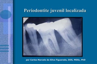 por Carlos Marcelo da Silva Figueredo, DDS, MDSc, PhD
Periodontite juvenil localizadaPeriodontite juvenil localizada
 
