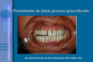 por Carlos Marcelo da Silva Figueredo, DDS, MDSc, PhD
Periodontite de inPeriodontite de iníício precoce generalizadacio precoce generalizada
 