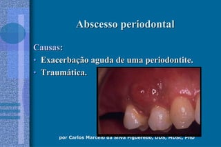 por Carlos Marcelo da Silva Figueredo, DDS, MDSc, PhD
Abscesso periodontalAbscesso periodontal
Causas:Causas:
•• ExacerbaExacerbaçção aguda de uma periodontite.ão aguda de uma periodontite.
•• TraumTraumáática.tica.
 