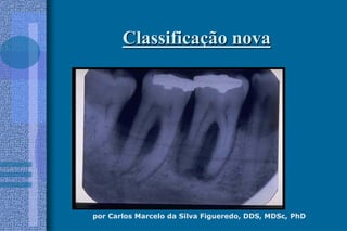 por Carlos Marcelo da Silva Figueredo, DDS, MDSc, PhD
ClassificaClassificaçção novaão nova
 