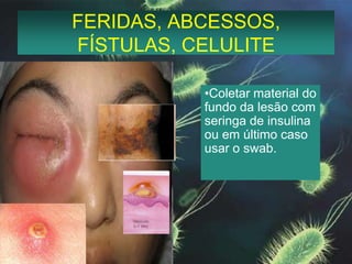 FERIDAS, ABCESSOS, FÍSTULAS, CELULITEColetar material do fundo da lesão com seringa de insulina ou em último caso usar o swab.HEMOCULTURAInfecções sistêmicas: 2-3 amostras de locais separados com 5 minutos entre as punções. Endocardite aguda: 3 amostras de 3 locais diferentes com intervalo de 15 a 30 minutos entre as punções. Endocardite subaguda: 3 amostras de 3 locais diferentes, de 15 em 15 minutos; se (-) em 24 hs, colher mais 3 amostras.Febre de origem indeterminada: 4-6 amostras com mais de 1 hora entre uma e outra em 48 h; se (-) após 24 hs, colher mais 2-3 amostras.Câncer e AIDS – duas a três amostras sendo uma para cultura de fungos.AMOSTRAS DE SÍTIOS DIFERENTES