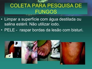 COLETA PARA PESQUISA DE FUNGOSCOURO CABELUDO – colocar alguns fios de cabelo da região afetada. Proceder raspagem das bordas e friccionar swab com salina estéril na região.