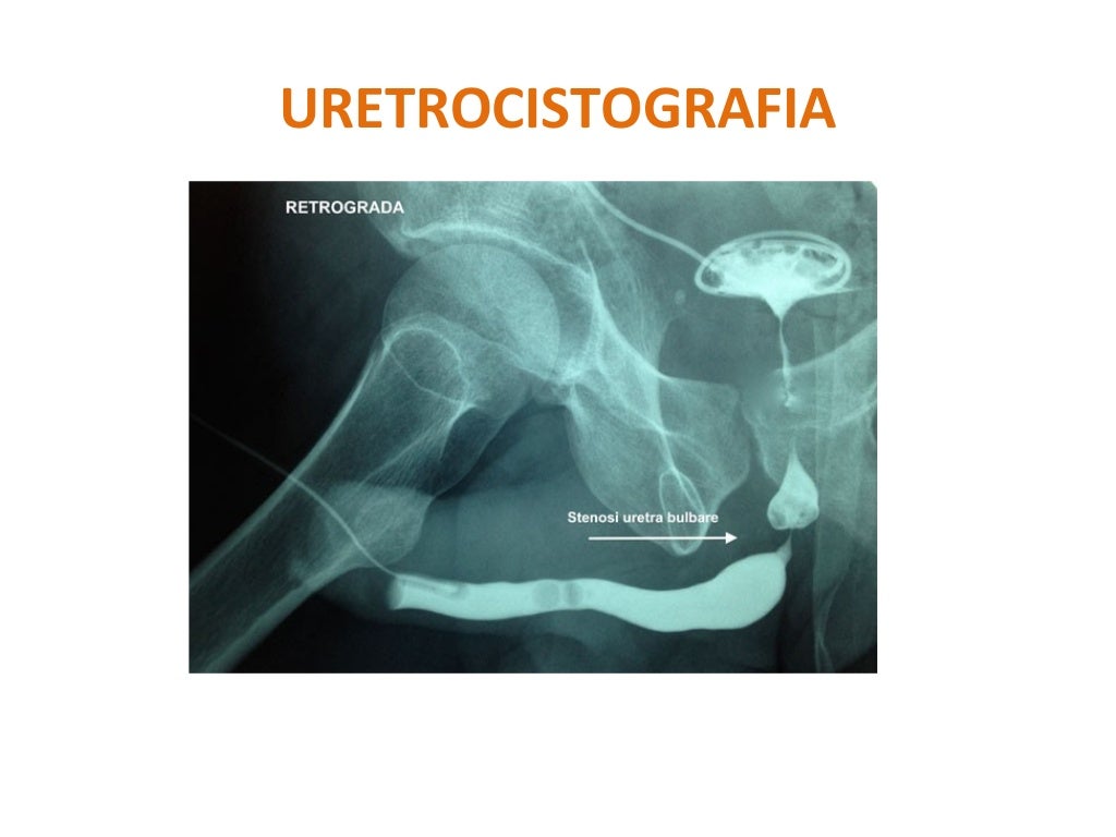Uretrocistografia Miccional E Retrógrada - RETOEDU