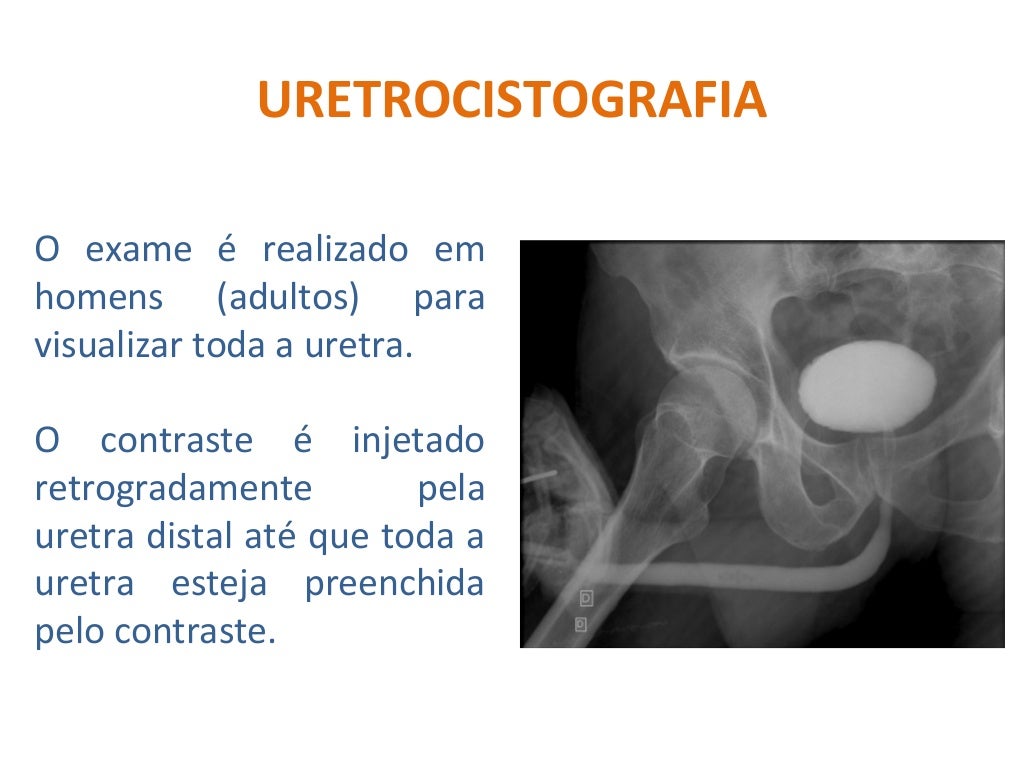Uretrocistografia Miccional E Retrógrada - RETOEDU