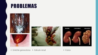 PROBLEMAS
• Uretrite gonocócica • Cálculo renal • Cistos
 
