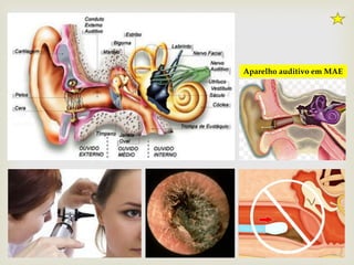 Aparelho auditivo em MAE
 