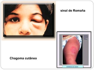 sinal de Romaña
Chagoma cutâneo
 