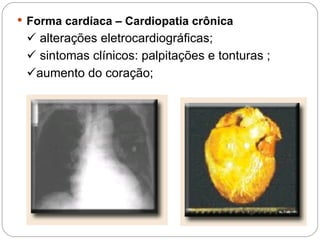  Forma cardíaca – Cardiopatia crônica
 alterações eletrocardiográficas;
 sintomas clínicos: palpitações e tonturas ;
aumento do coração;
 