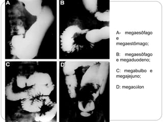 A- megaesôfago
e
megaestômago;
B: megaesôfago
e megaduodeno;
C: megabulbo e
megajejuno;
D: megacólon
 