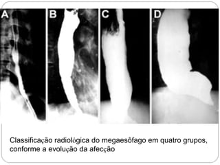 Classificação radiológica do megaesôfago em quatro grupos,
conforme a evolução da afecção
 