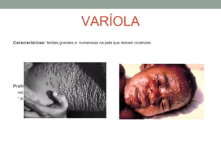 Características: feridas grandes e numerosas na pele que deixam cicatrizes.
Profilaxia:
vacinação
* doença já erradicada
VARÍOLA
 
