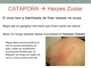 O virus tem a habilidade de ficar latente no corpo
Migra ate os ganglios nervosos que ficam perto da coluna
Apos um longo periodo (baixa imunidade) Herpes Zoster
CATAPORA  Herpes Zoster
Migra pelos nervos perifericos
ate os nervos sensoriais da
pele, onder se manifestam
provocando feridas que se
dispoem ao longo do trajeto do
nervo e que causa muita dor
 