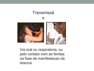Transmissã
o
Via oral ou respiratoria, ou
pelo contato com as feridas
na fase de manifestacao da
doenca
 