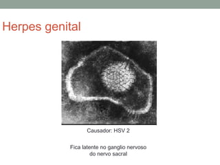 Herpes genital
Causador: HSV 2
Fica latente no ganglio nervoso
do nervo sacral
 