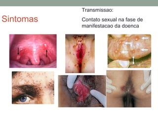 Sintomas
Transmissao:
Contato sexual na fase de
manifestacao da doenca
 