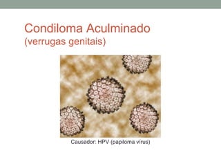 Condiloma Aculminado
(verrugas genitais)
Causador: HPV (papiloma vírus)
 