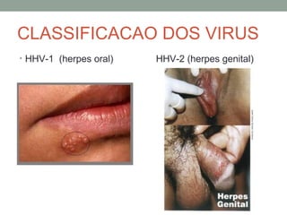 CLASSIFICACAO DOS VIRUS
• HHV-1 (herpes oral) HHV-2 (herpes genital)
 