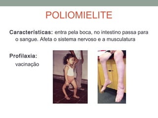 Características: entra pela boca, no intestino passa para
o sangue. Afeta o sistema nervoso e a musculatura
Profilaxia:
vacinação
POLIOMIELITE
 