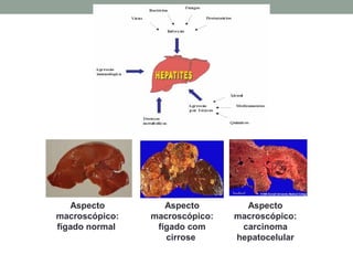 Aspecto
macroscópico:
fígado normal
Aspecto
macroscópico:
carcinoma
hepatocelular
Aspecto
macroscópico:
fígado com
cirrose
 