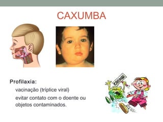 Profilaxia:
vacinação (tríplice viral)
evitar contato com o doente ou com
objetos contaminados.
CAXUMBA
 