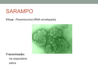 Vírus: Paramixovirus (RNA envelopado)
Transmissão:
via respiratória
saliva
SARAMPO
 