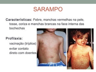 Características: Febre, manchas vermelhas na pele,
tosse, coriza e manchas brancas na face interna das
bochechas
Profilaxia:
vacinação (tríplice)
evitar contato
direto com doentes
SARAMPO
 