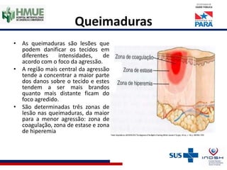Queimaduras
• As queimaduras são lesões que
podem danificar os tecidos em
diferentes intensidades, de
acordo com o foco da agressão.
• A região mais central da agressão
tende a concentrar a maior parte
dos danos sobre o tecido e estes
tendem a ser mais brandos
quanto mais distante ficam do
foco agredido.
• São determinadas três zonas de
lesão nas queimaduras, da maior
para a menor agressão: zona de
coagulação, zona de estase e zona
de hiperemia
 
