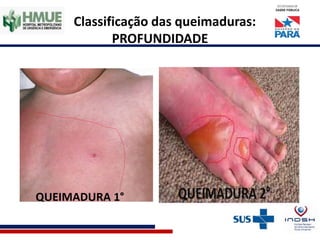 Classificação das queimaduras:
PROFUNDIDADE
 