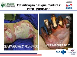 Classificação das queimaduras:
PROFUNDIDADE
 