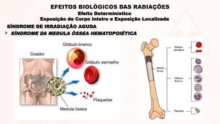 SÍNDROME DE IRRADIAÇÃO AGUDA
 SÍNDROME DA MEDULA ÓSSEA HEMATOPOIÉTICA
Efeito Determinístico
Exposição de Corpo Inteiro e Exposição Localizada
EFEITOS BIOLÓGICOS DAS RADIAÇÕES
 