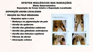  REAÇÃO DA PELE IRRADIADA
o Sequelas após a cura
 Mudança na pigmentação da pele
 Atrofia da epiderme
 Atrofia das glândulas sebáceas
 Atrofia das glândulas sudoríparas
 Atrofia dos folículos capilares
 Fibrose da derme
 Ulceração crônica
EXPOSIÇÃO AGUDA LOCALIZADA
Efeito Determinístico
Exposição de Corpo Inteiro e Exposição Localizada
EFEITOS BIOLÓGICOS DAS RADIAÇÕES
 