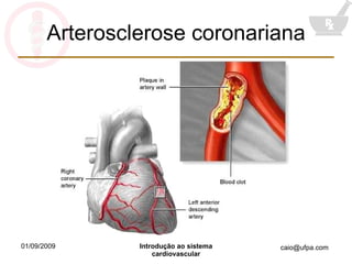 Arterosclerose coronariana 