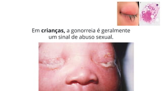 Em crianças, a gonorreia é geralmente
um sinal de abuso sexual.
 
