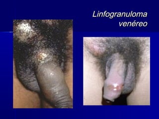 Linfogranuloma
       venéreo
 