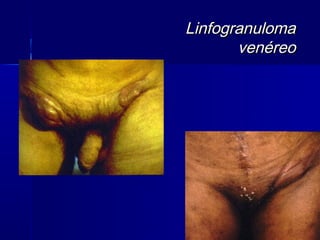 Linfogranuloma
       venéreo
 