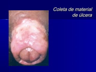 Coleta de material
         de úlcera
 