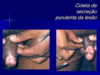 Coleta de
         secreção
purulenta da lesão
 