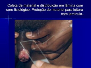 Coleta de material e distribuição em lâmina com
soro fisiológico. Proteção do material para leitura
                                    com lamínula.
 