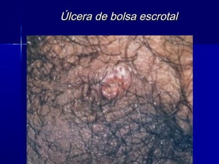 Úlcera de bolsa escrotal
 