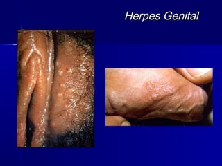 Herpes Genital
 
