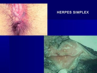 HERPES SIMPLEX
 