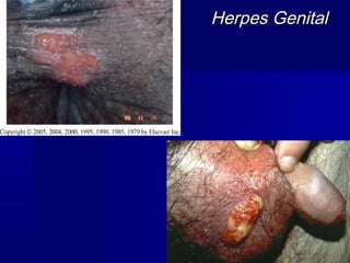 Herpes Genital
 