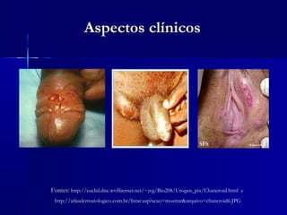 Aspectos clínicos




Fontes: http://euclid.dne.wvfibernet.net/~jvg/Bio208/Urogen_pix/Chancroid.html e
 http://atlasdermatologico.com.br/listar.asp?acao=mostrar&arquivo=chancroid6.JPG
 