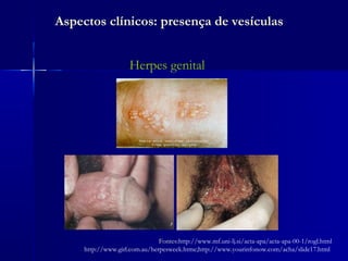 Aspectos clínicos: presença de vesículas


                     Herpes genital




                               Fontes:http://www.mf.uni-lj.si/acta-apa/acta-apa-00-1/rogl.html
     http://www.girl.com.au/herpesweek.htme;http://www.yourinfonow.com/acha/slide17.html
 