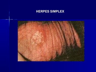 HERPES SIMPLEX
 