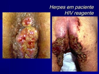 Herpes em paciente
      HIV reagente
 